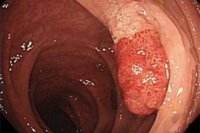 大腸カメラ（大腸内視鏡）検査
