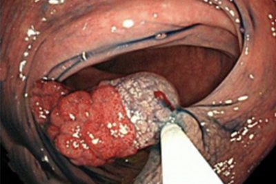 大腸カメラ（大腸内視鏡）検査