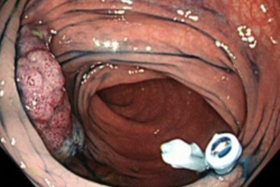 大腸カメラ（大腸内視鏡）検査