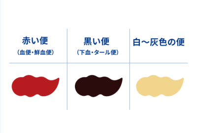 大腸がんの便の色は?血便などの“便からわかる危険信号”を解説!