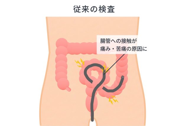 大腸カメラ（大腸内視鏡）検査